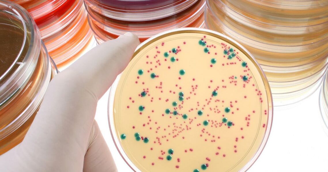 Chronic bacterial prostatitis is detected by analyzing urine and prostate secretions
