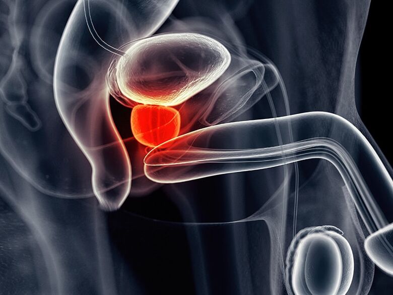 Inflammation of the prostate gland that accompanies chronic prostatitis