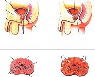 normal prostatitis and chronic prostatitis